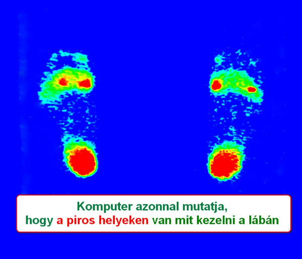 Lábtartás mérés monitoron